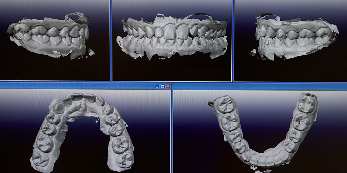 Digital Intraoral Scanner images