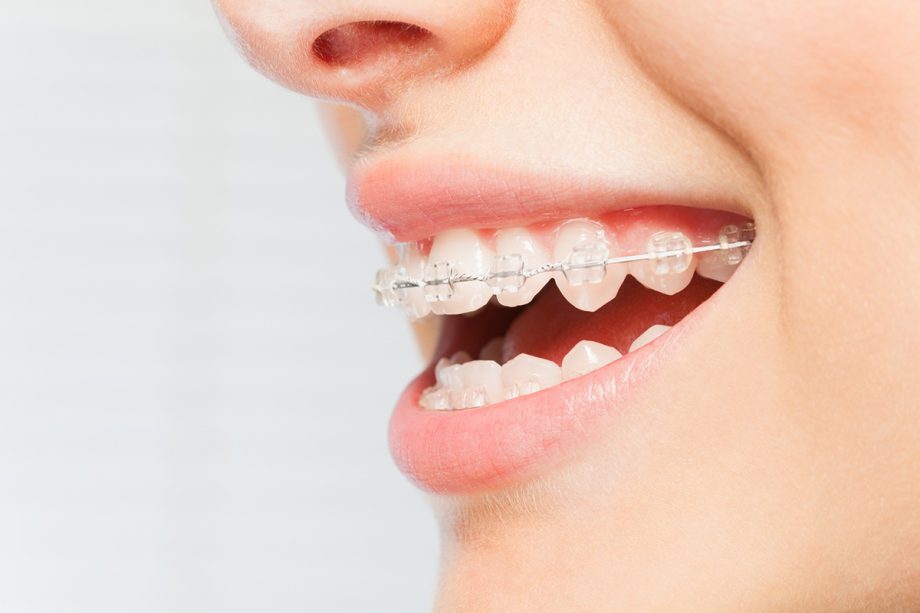 Do Clear Brackets Stain