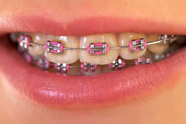 Smile with regular metal braces