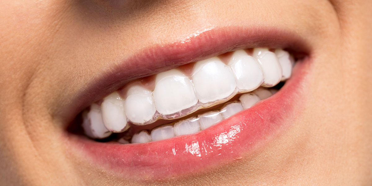 Clear aligner smile