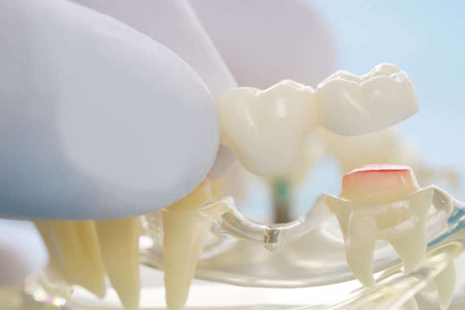 dental bridge image