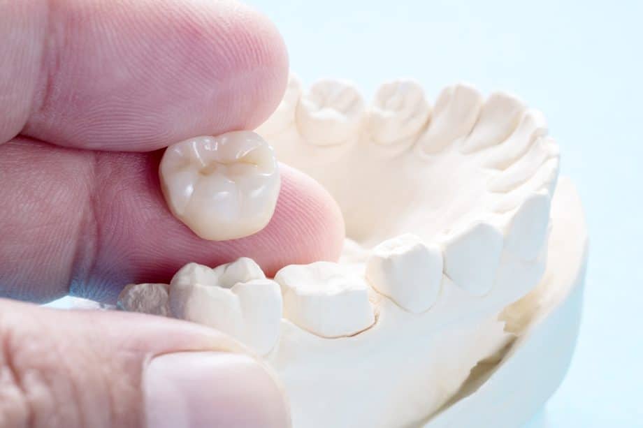How Much Does A Dental Crown Cost in  Guelph, ON?