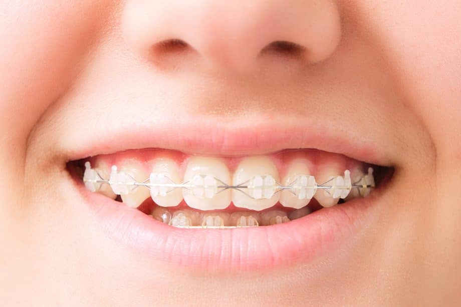 What To Expect At An Orthodontist Consultation